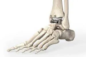 Total Ankle Arthroplasty