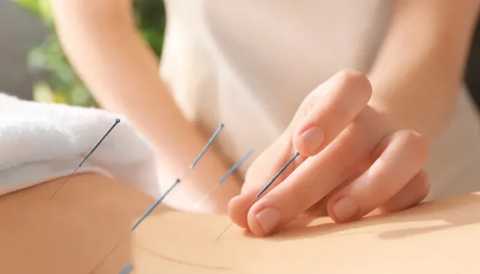 What is Dry Needling?