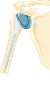 Reverse Total Shoulder Replacement Precautions