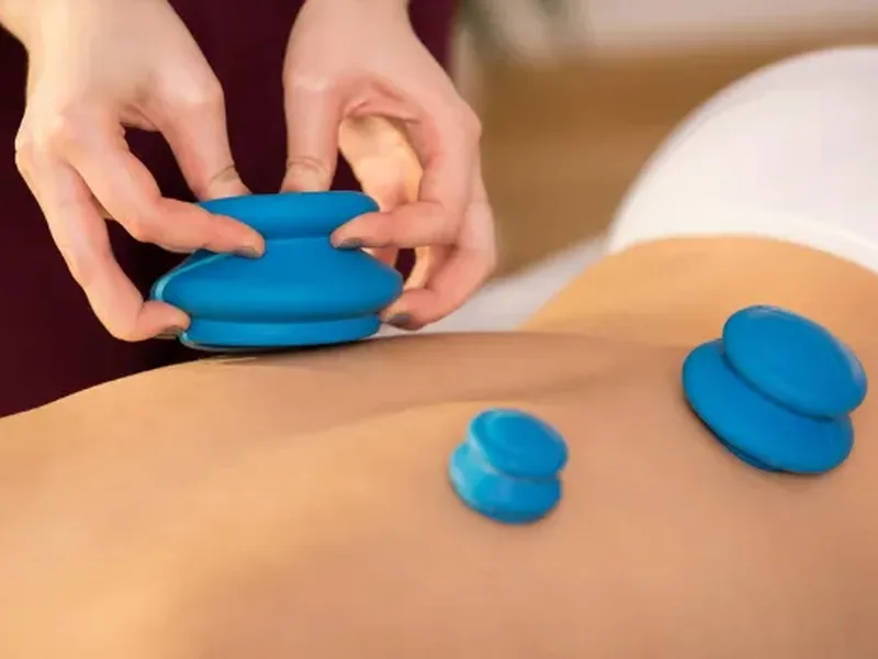 Physical therapist applying cupping to a patient's upper back