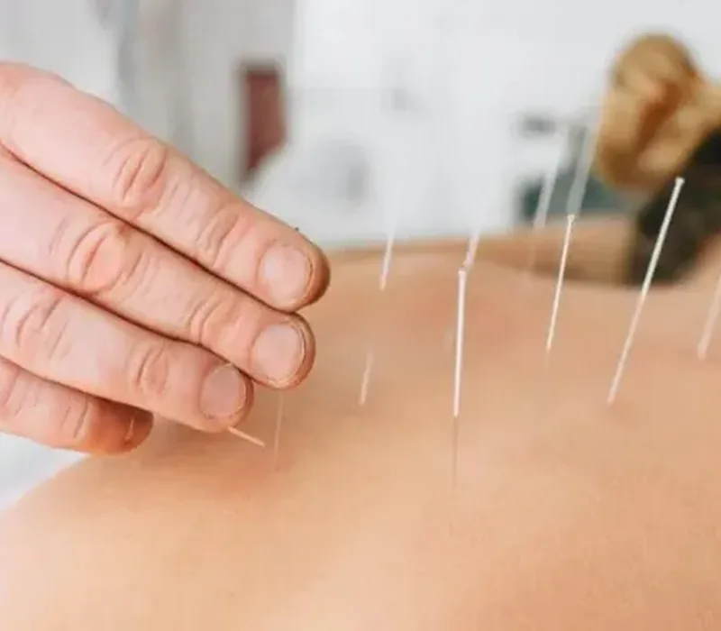 Clinician performing dry needling trigger-point treatment