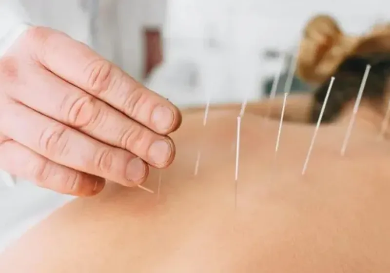 Clinician performing dry needling trigger-point treatment