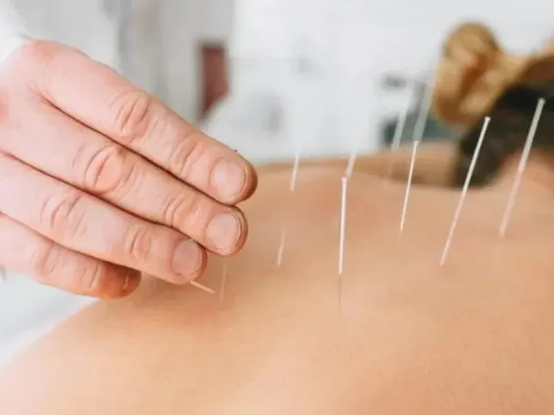 Physical therapist performing dry needling on a patient's shoulder