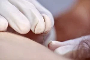 5 Things You Should Know About Dry Needling Therapy