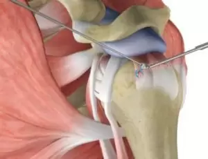 When Not to Have Rotator Cuff Surgery